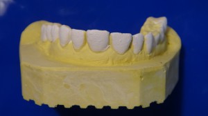 تری بلیچینگ پروتز دندان Bleaching tray