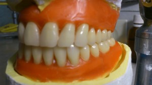 Cross Bite پروتز کامل متحرک